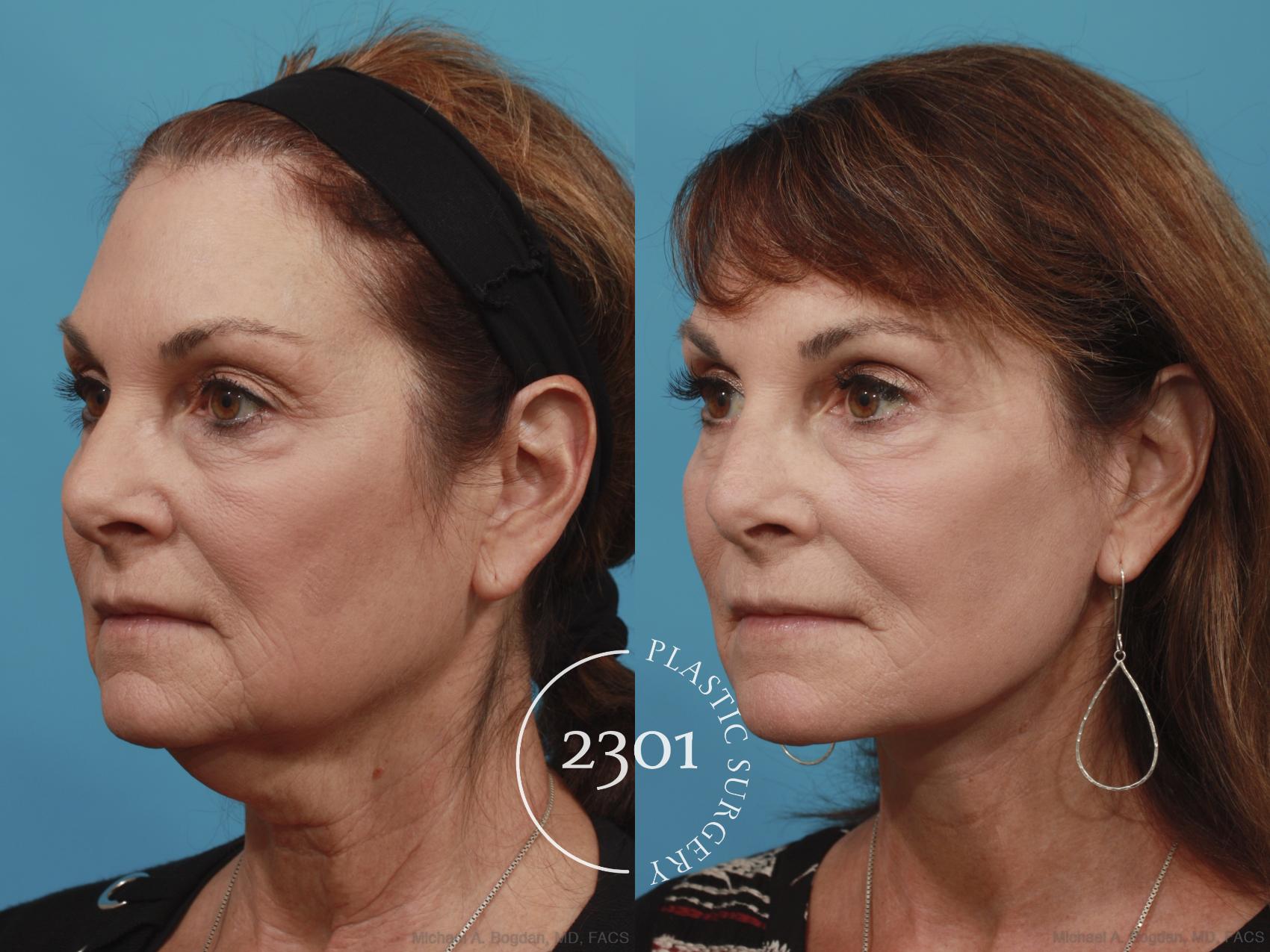 Before & After Face Lift Case 635 Left Oblique View in Fort Worth, Plano, & Frisco, Texas