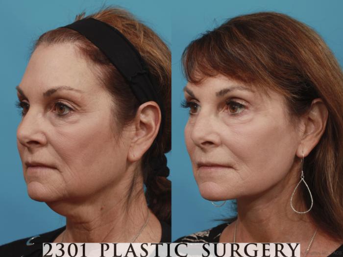Before & After Face Lift Case 635 Left Oblique View in Fort Worth, Plano, & Frisco, Texas