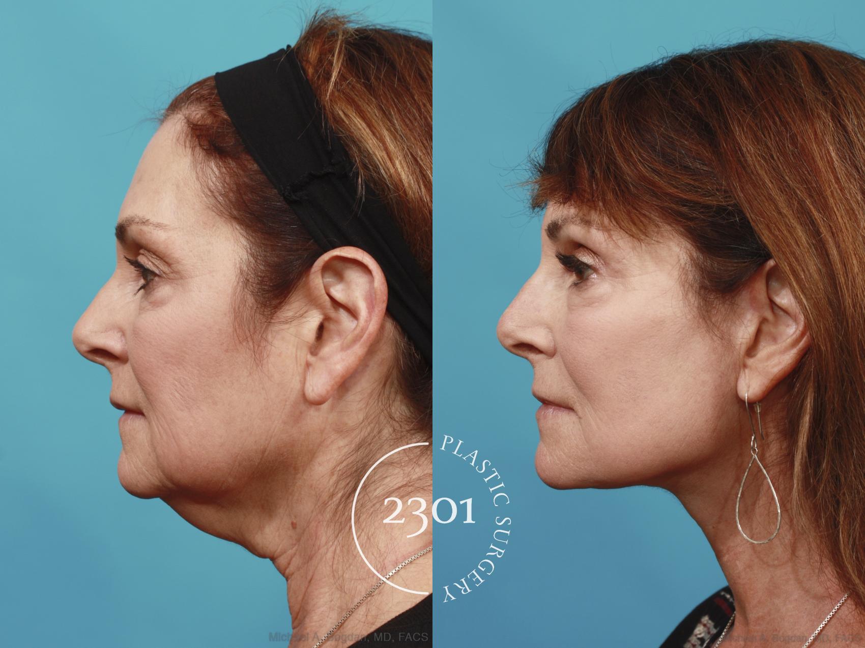 Before & After Face Lift Case 635 Left Side View in Fort Worth, Plano, & Frisco, Texas