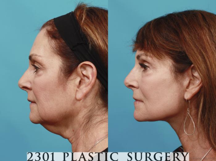 Before & After Face Lift Case 635 Left Side View in Fort Worth, Plano, & Frisco, Texas