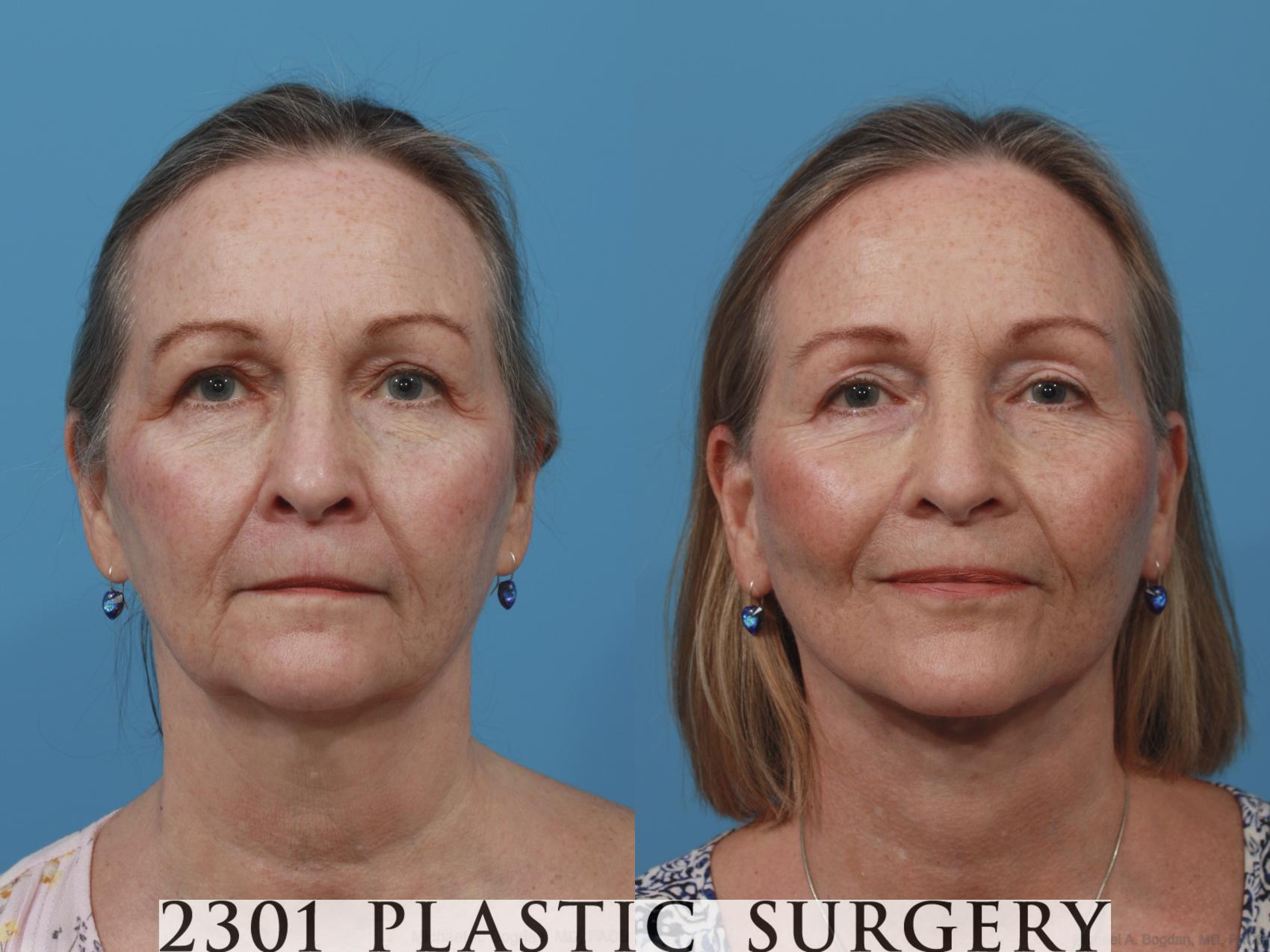 Before & After Face Lift Case 636 Front View in Fort Worth, Plano, & Frisco, Texas