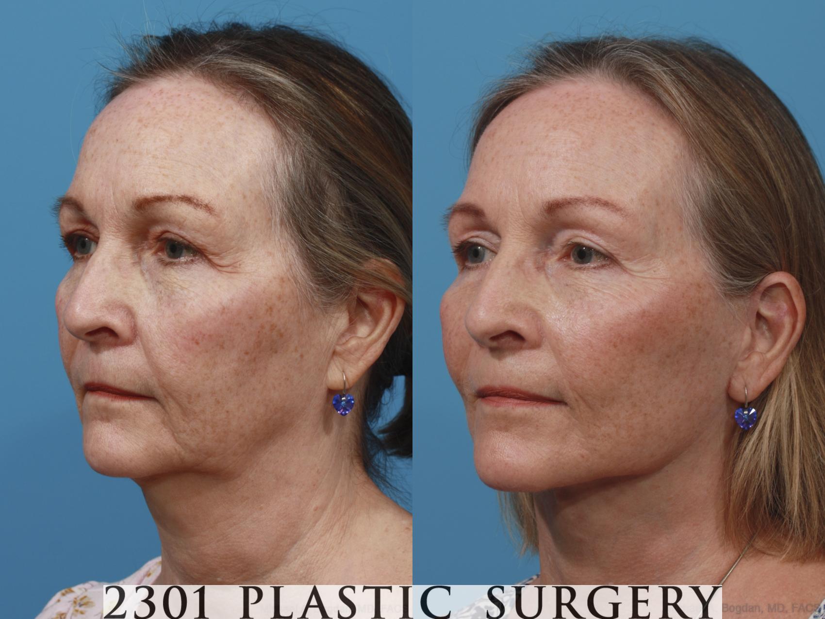 Before & After Face Lift Case 636 Left Oblique View in Fort Worth & Frisco, Texas