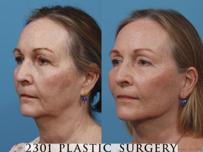 Before & After Face Lift Case 636 Left Oblique View in Fort Worth, Plano, & Frisco, Texas