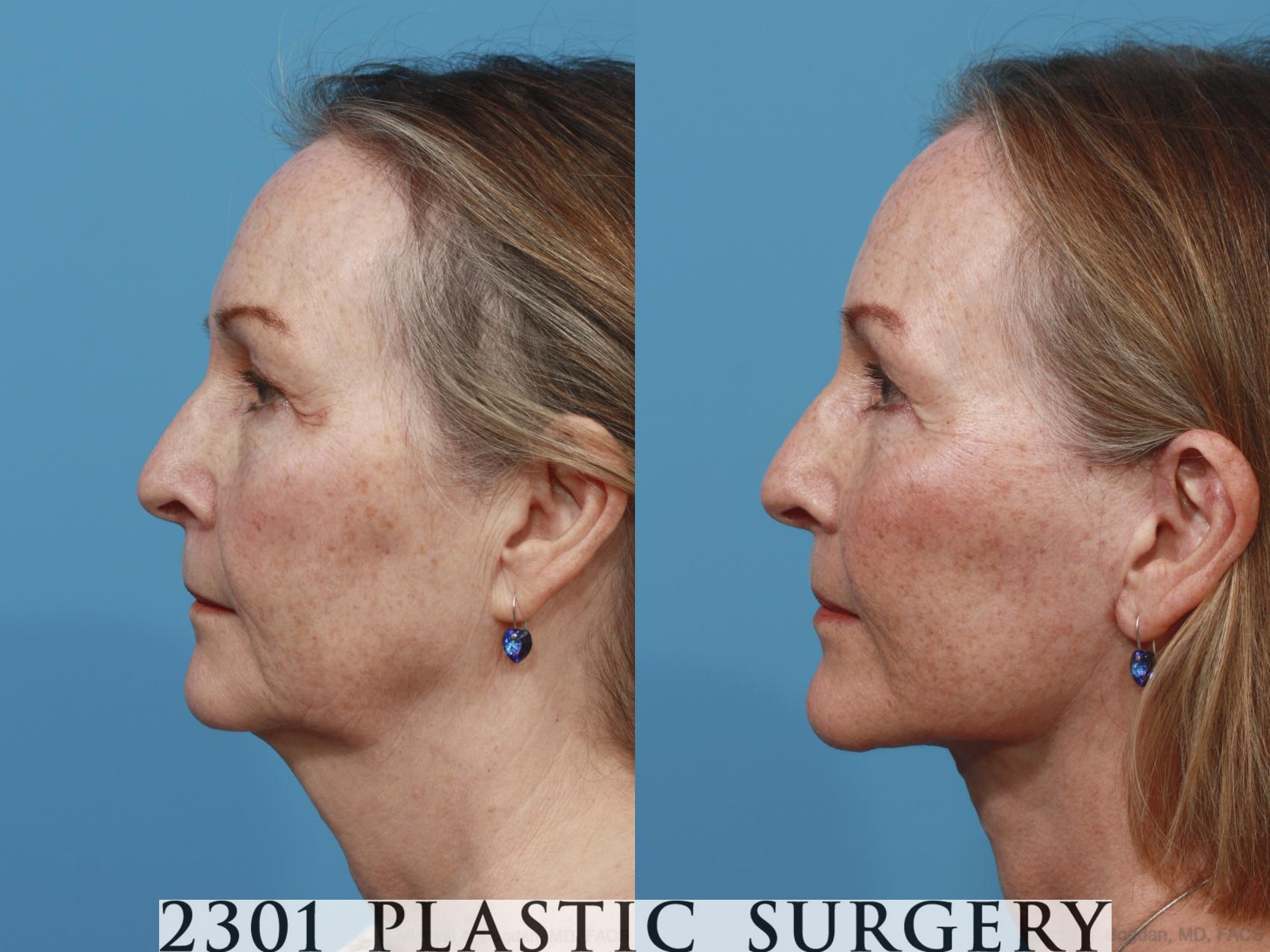 Before & After Face Lift Case 636 Left Side View in Fort Worth & Frisco, Texas