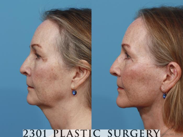 Before & After Face Lift Case 636 Left Side View in Fort Worth, Plano, & Frisco, Texas