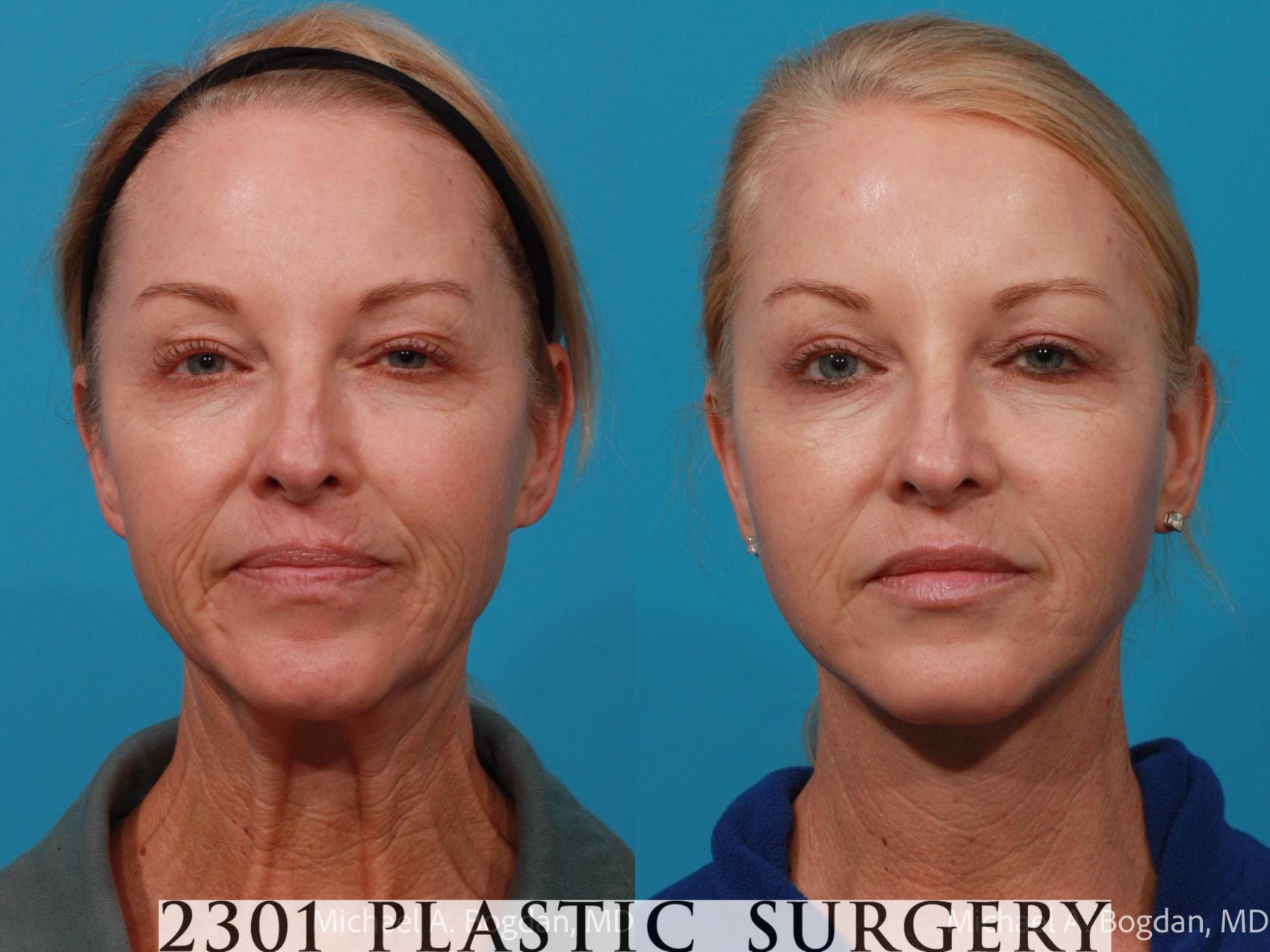 Before & After Face Lift Case 676 Front View in Fort Worth & Frisco, Texas