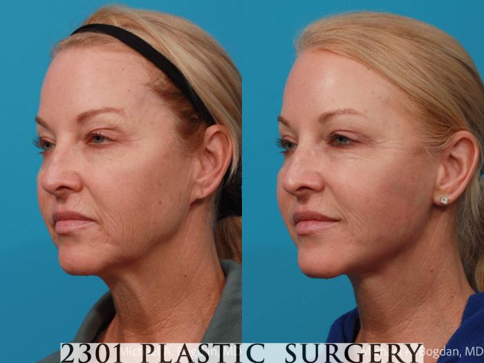Before & After Face Lift Case 676 Left Oblique View in Fort Worth, Plano, & Frisco, Texas
