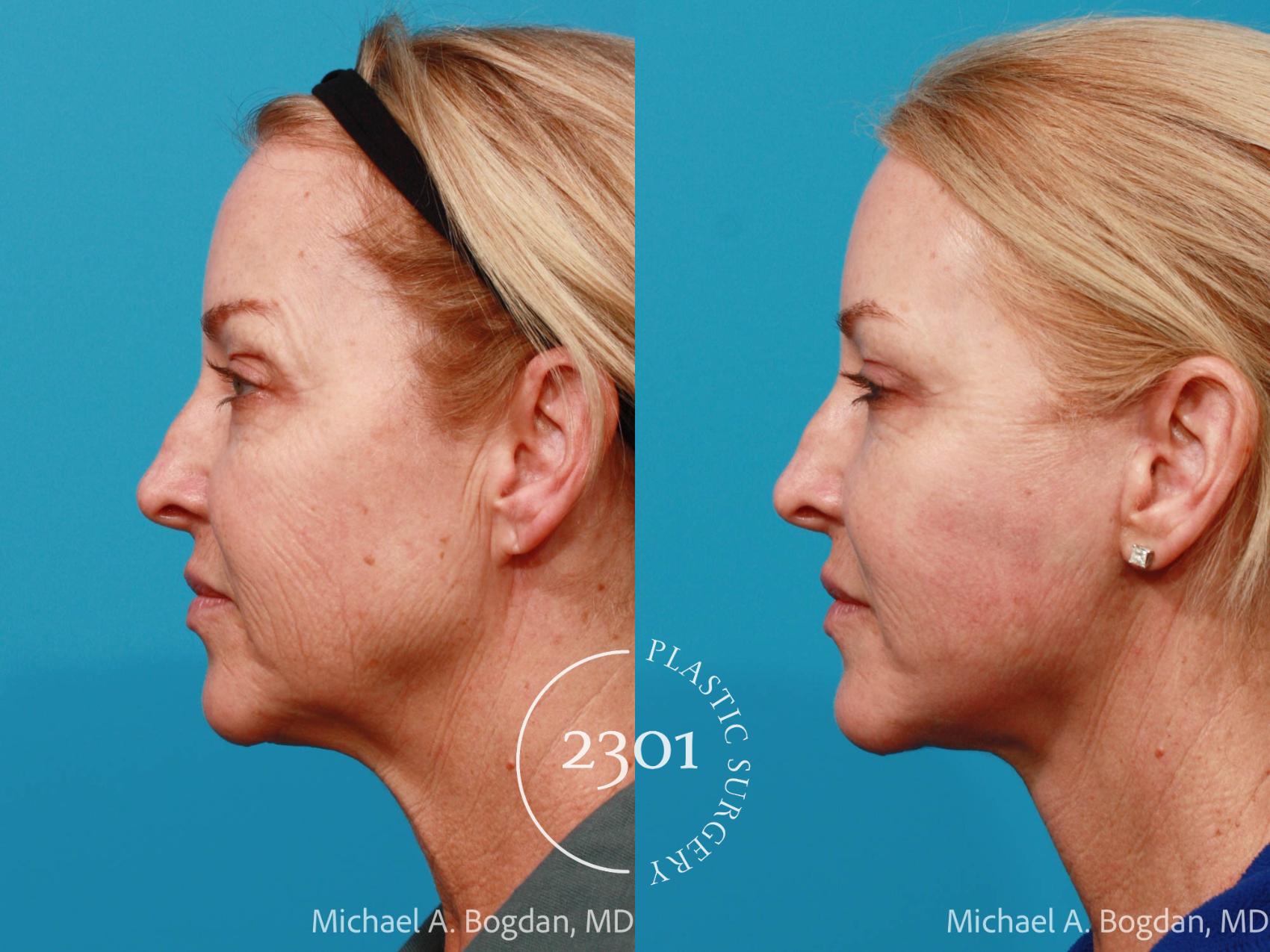 Before & After Face Lift Case 676 Left Side View in Fort Worth, Plano, & Frisco, Texas