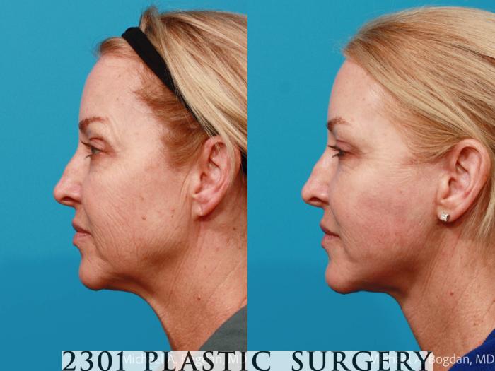Before & After Face Lift Case 676 Left Side View in Fort Worth, Plano, & Frisco, Texas