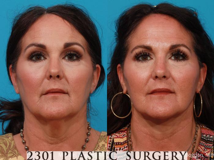 Before & After Neck Lift Case 690 Front View in Fort Worth, Plano, & Frisco, Texas