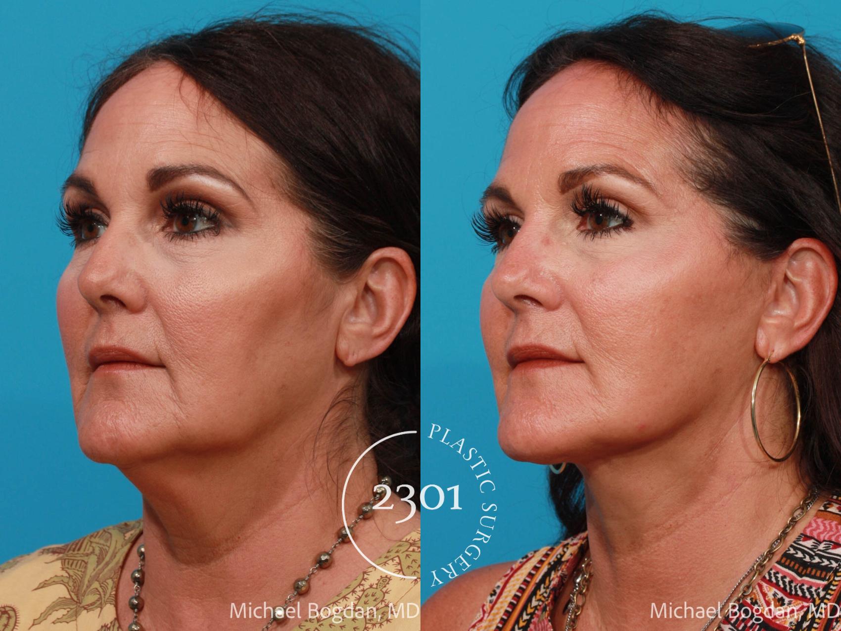Before & After Face Lift Case 690 Left Oblique View in Fort Worth, Plano, & Frisco, Texas