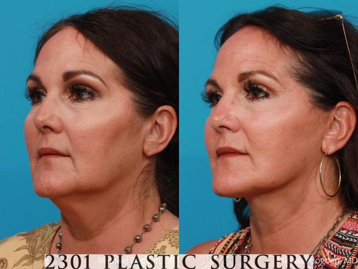 Before & After Neck Lift Case 690 Left Oblique View in Fort Worth, Plano, & Frisco, Texas