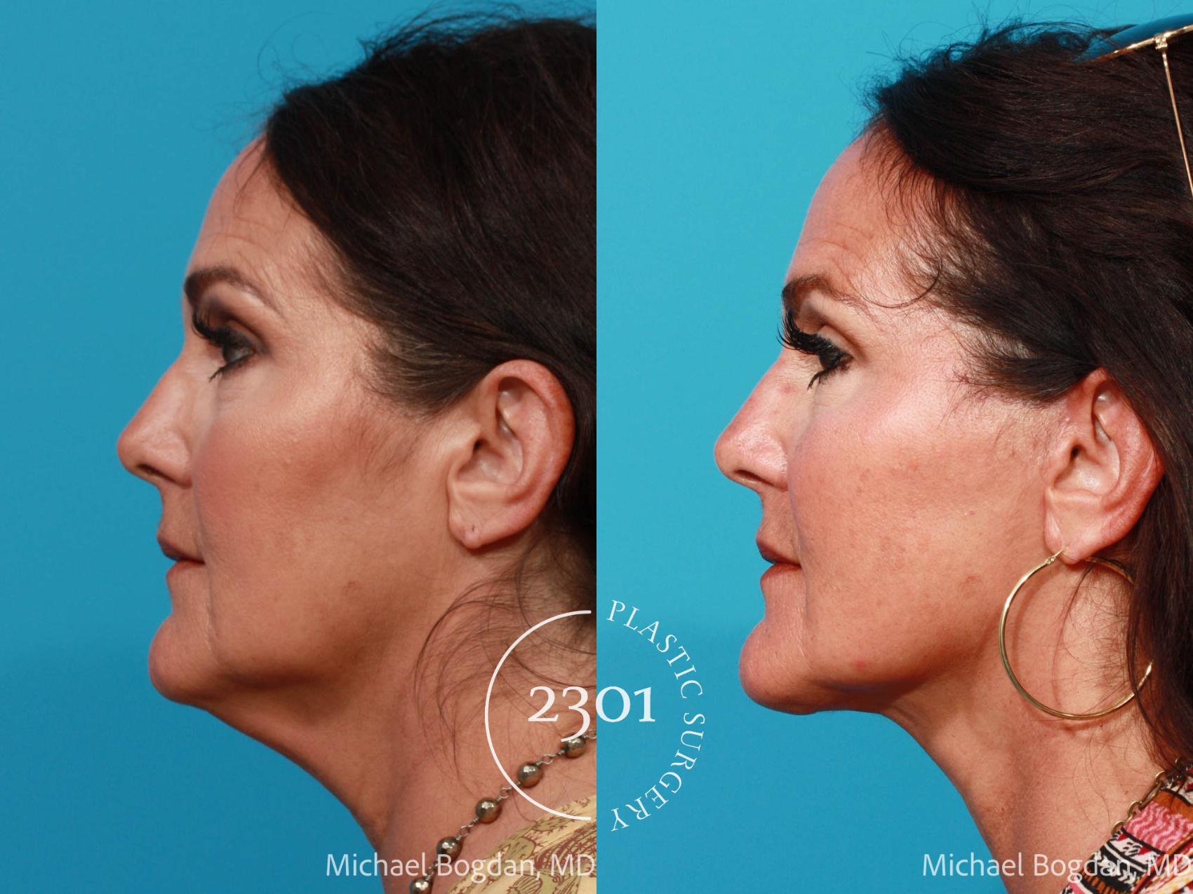 Before & After Face Lift Case 690 Left Side View in Fort Worth, Plano, & Frisco, Texas