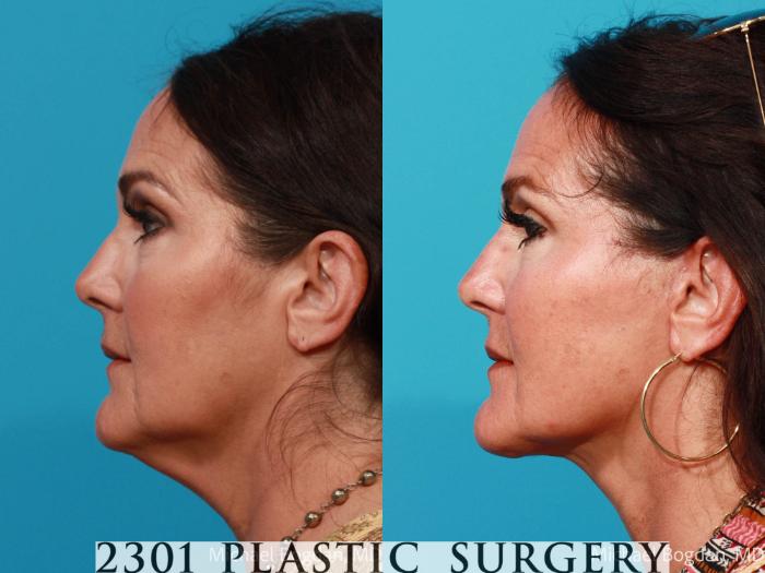 Before & After Face Lift Case 690 Left Side View in Fort Worth, Plano, & Frisco, Texas