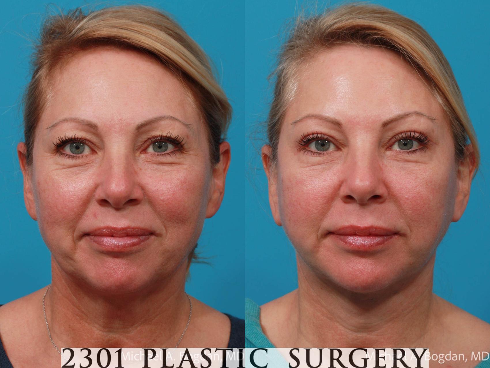 Before & After Face Lift Case 701 Front View in Fort Worth, Plano, & Frisco, Texas