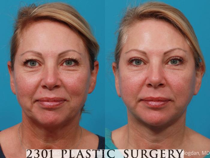Before & After Face Lift Case 701 Front View in Fort Worth, Plano, & Frisco, Texas