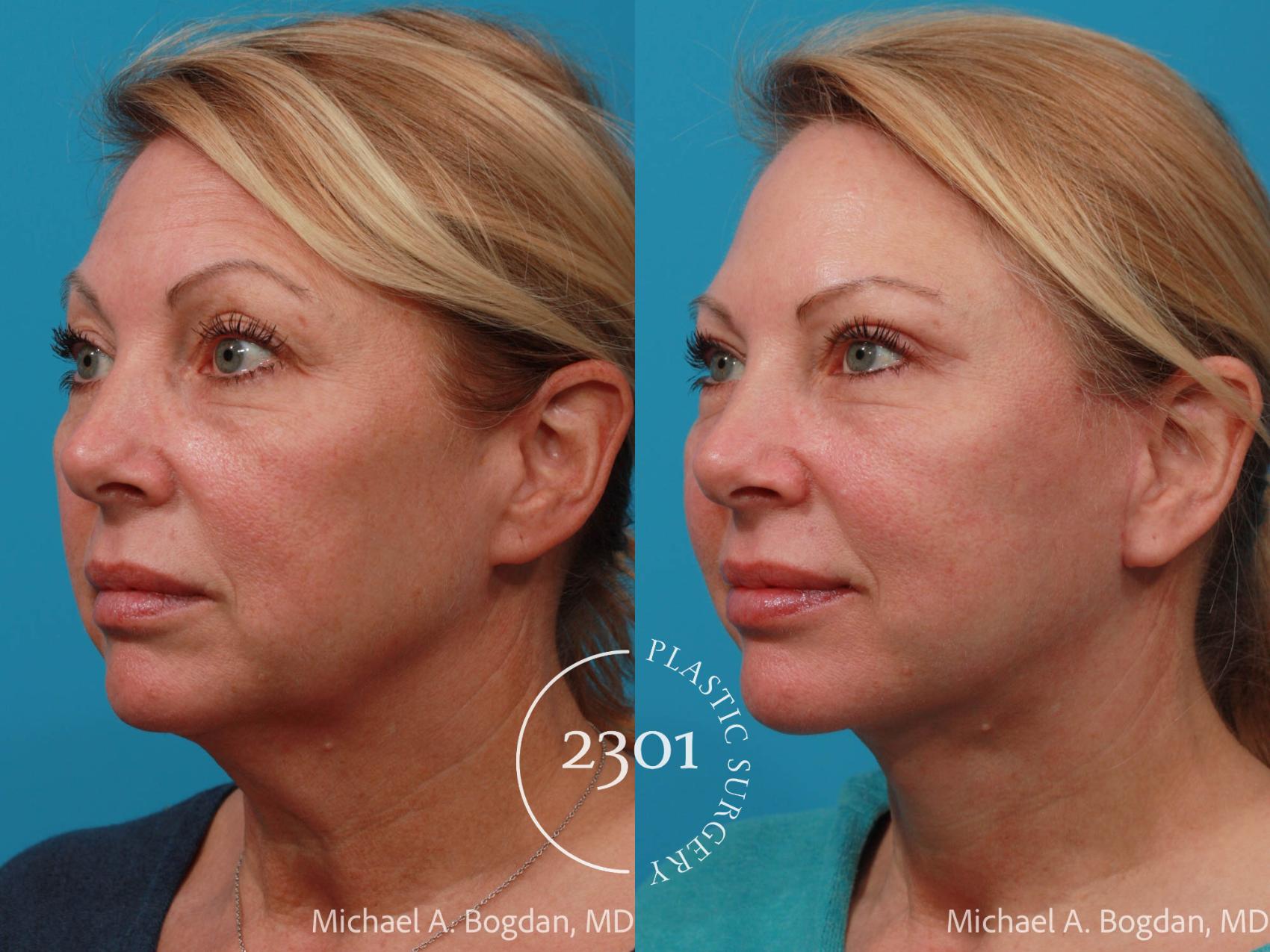 Before & After Blepharoplasty Case 701 Left Oblique View in Fort Worth, Plano, & Frisco, Texas