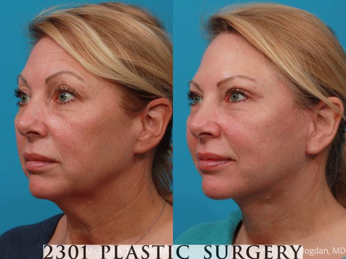 Before & After Face Lift Case 701 Left Oblique View in Fort Worth, Plano, & Frisco, Texas