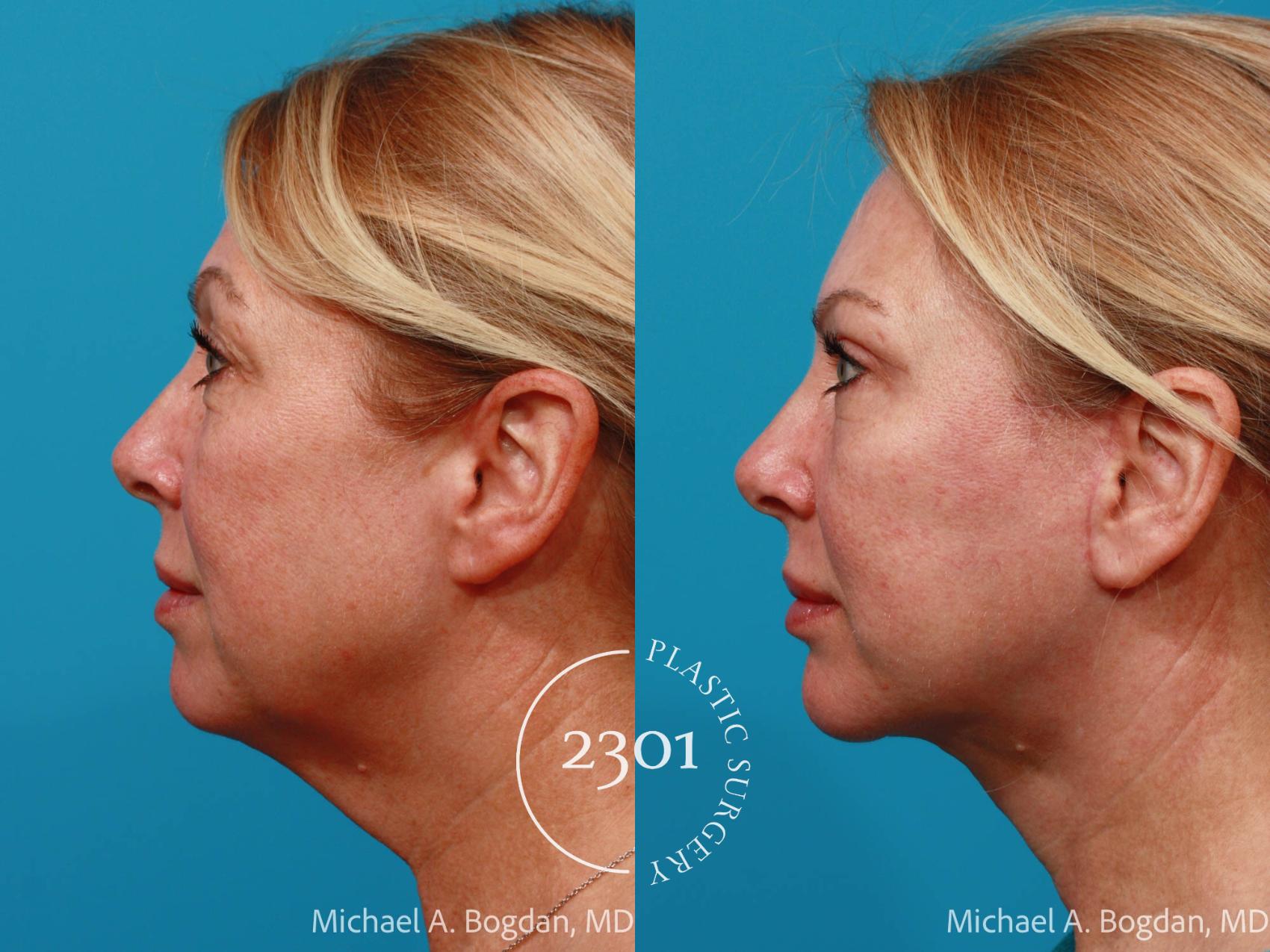 Before & After Blepharoplasty Case 701 Left Side View in Fort Worth, Plano, & Frisco, Texas