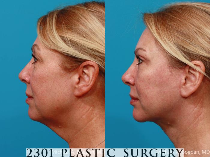 Before & After Blepharoplasty Case 701 Left Side View in Fort Worth, Plano, & Frisco, Texas