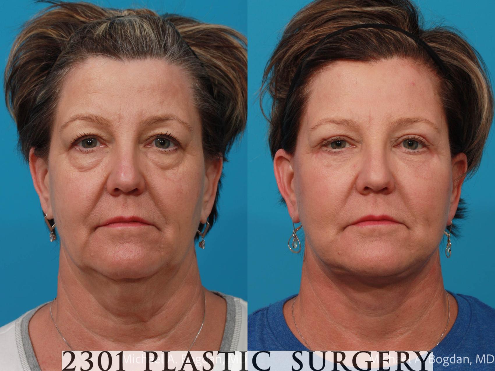 Before & After Face Lift Case 724 Front View in Fort Worth, Plano, & Frisco, Texas