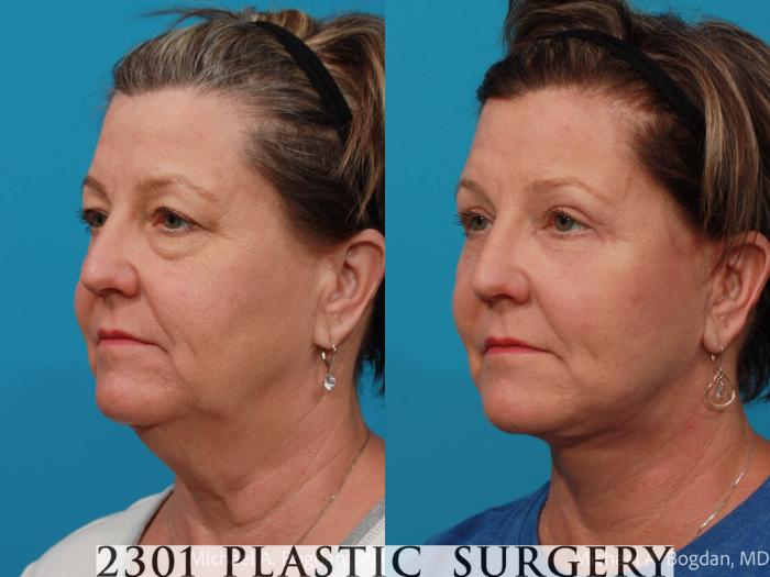 Before & After Face Lift Case 724 Left Oblique View in Fort Worth, Plano, & Frisco, Texas