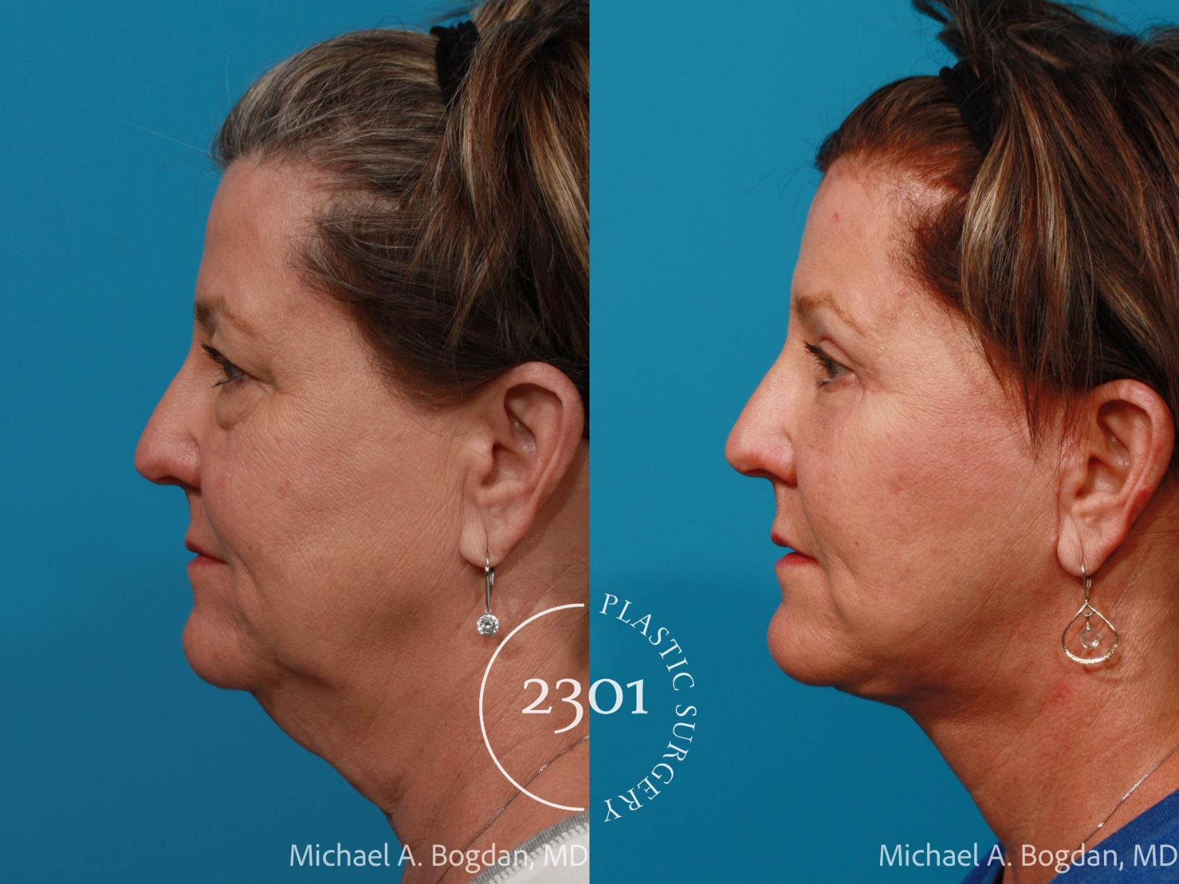 Before & After Face Lift Case 724 Left Side View in Fort Worth, Plano, & Frisco, Texas