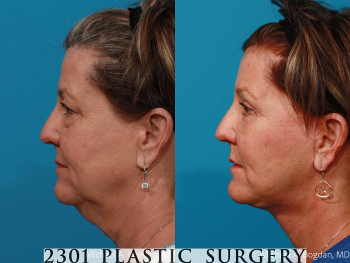 Before & After Face Lift Case 724 Left Side View in Fort Worth, Plano, & Frisco, Texas