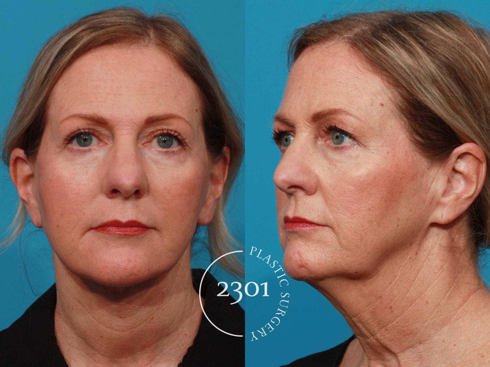 Before & After Face Lift Case 726 Front View in Fort Worth, Plano, & Frisco, Texas