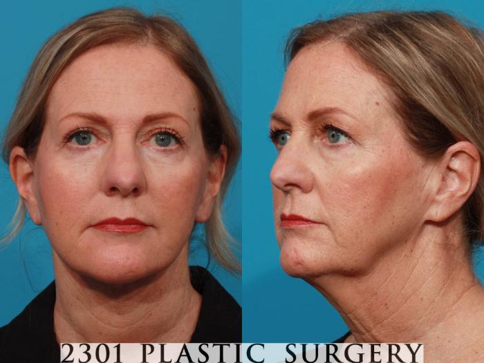 Before & After Blepharoplasty Case 726 Front View in Fort Worth, Plano, & Frisco, Texas
