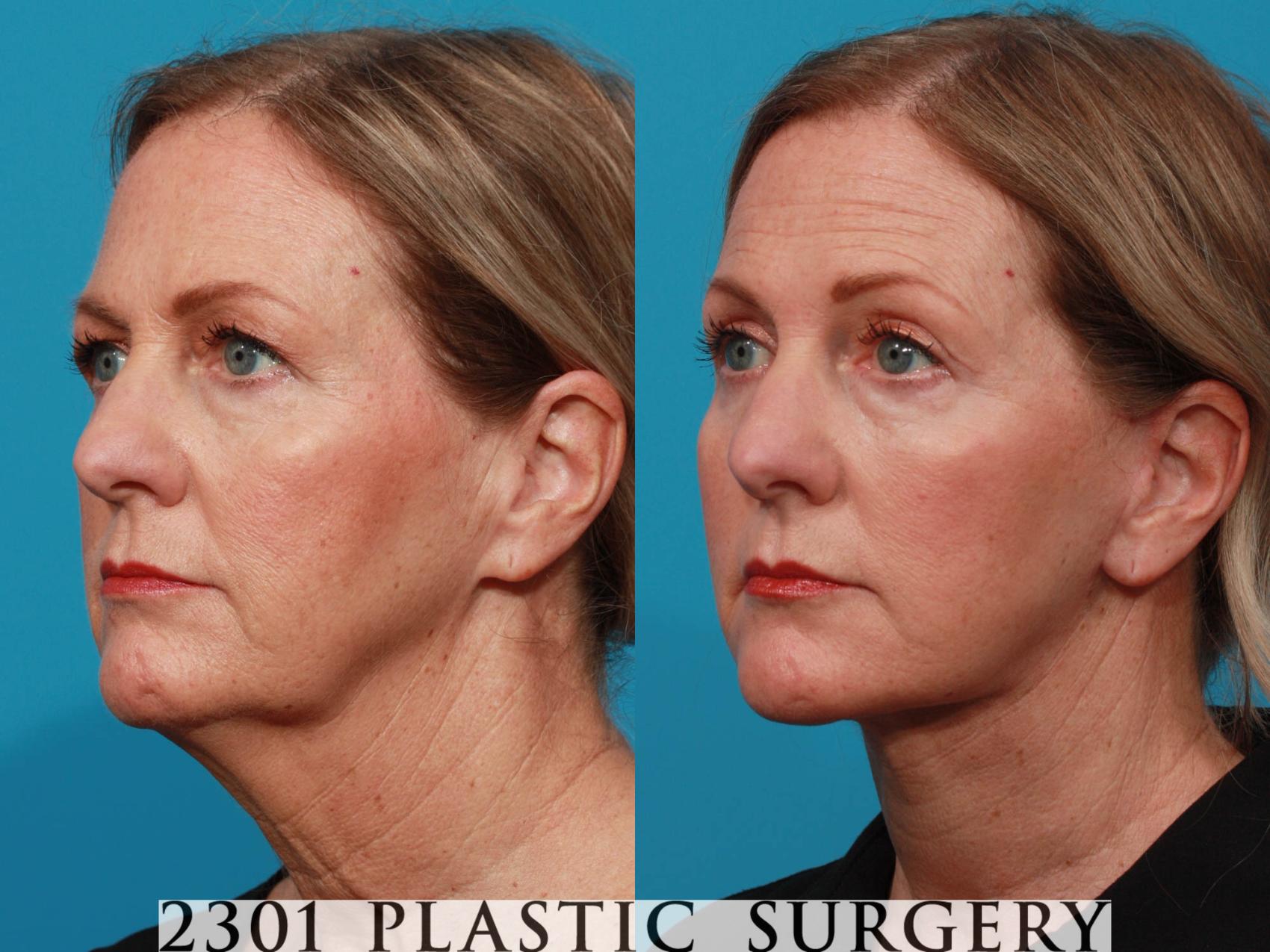 Before & After Face Lift Case 726 Left Oblique View in Fort Worth & Frisco, Texas