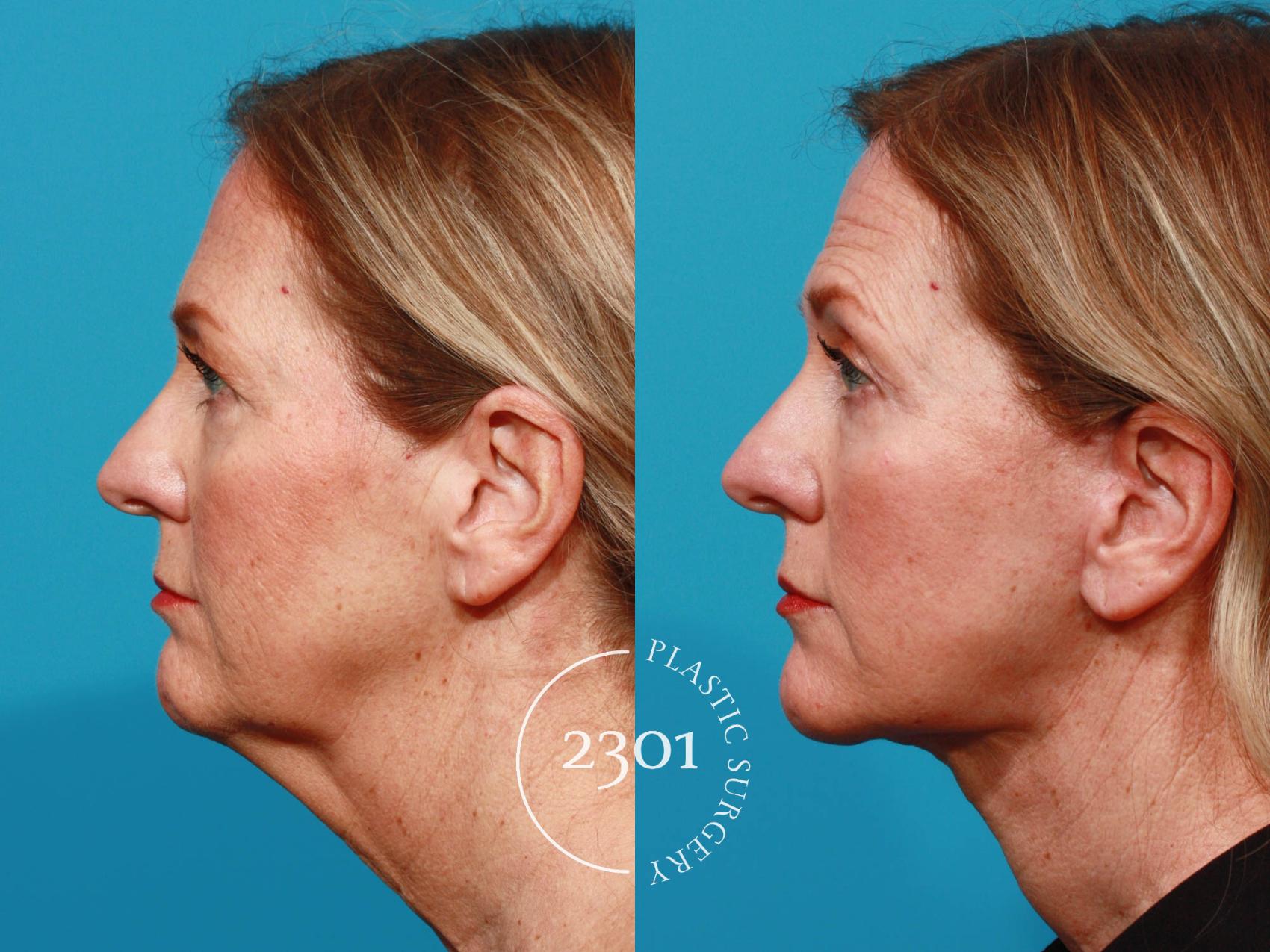 Before & After Face Lift Case 726 Left Side View in Fort Worth, Plano, & Frisco, Texas