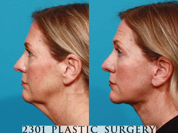 Before & After Blepharoplasty Case 726 Left Side View in Fort Worth, Plano, & Frisco, Texas