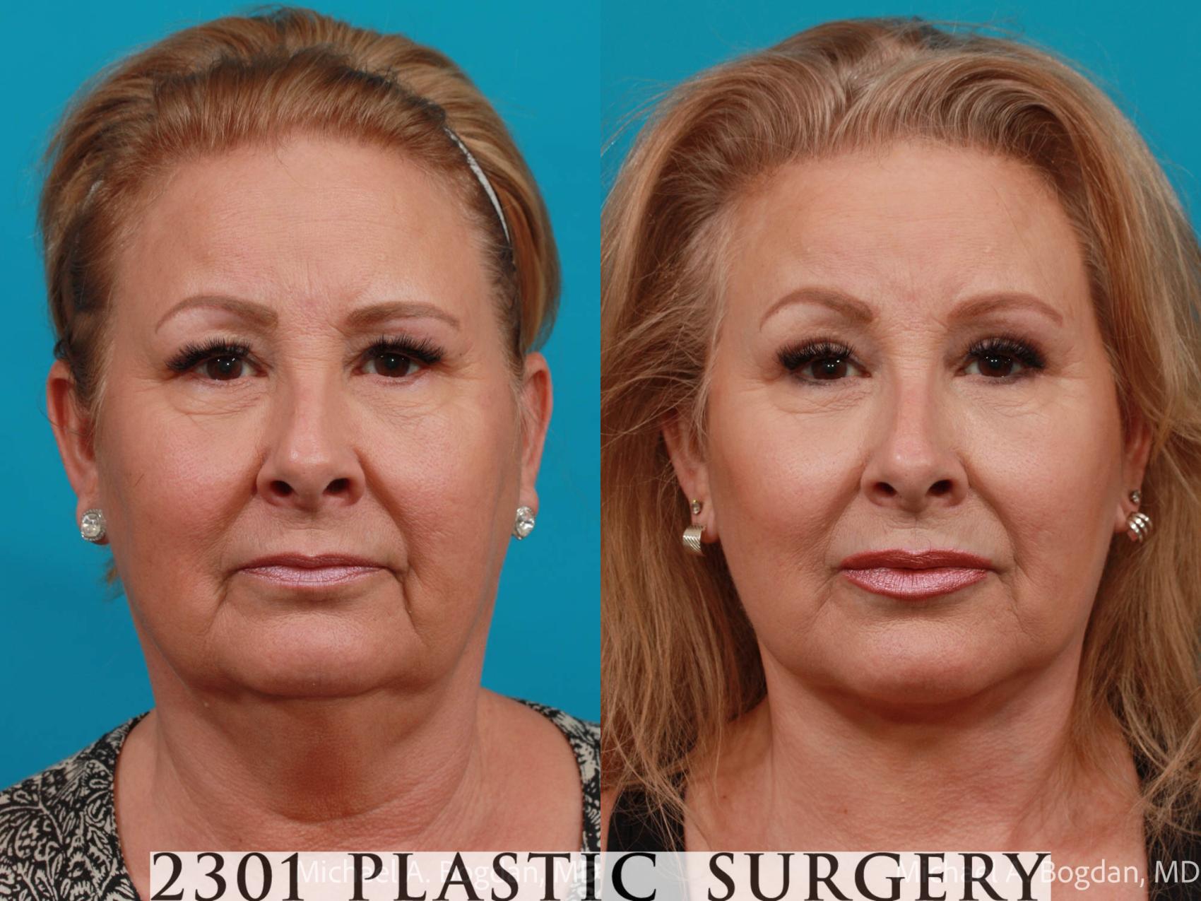 Before & After Blepharoplasty Case 727 Front View in Fort Worth & Frisco, Texas