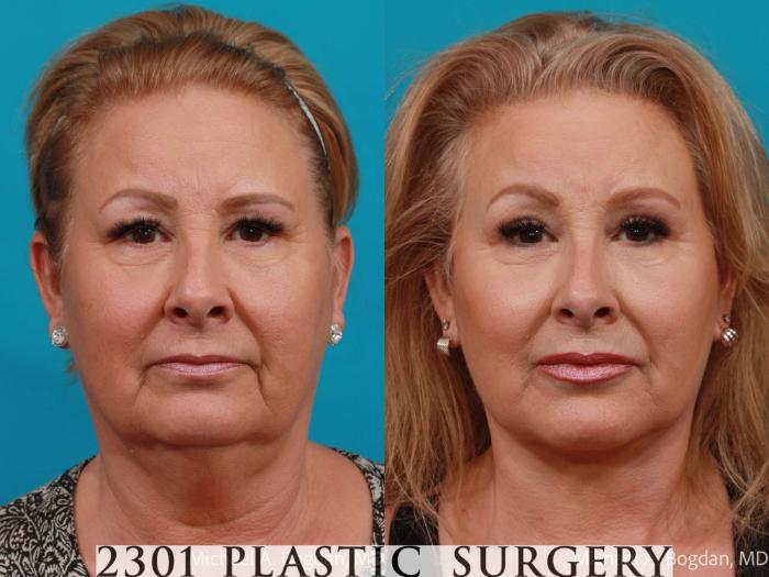 Before & After Neck Lift Case 727 Front View in Fort Worth, Plano, & Frisco, Texas