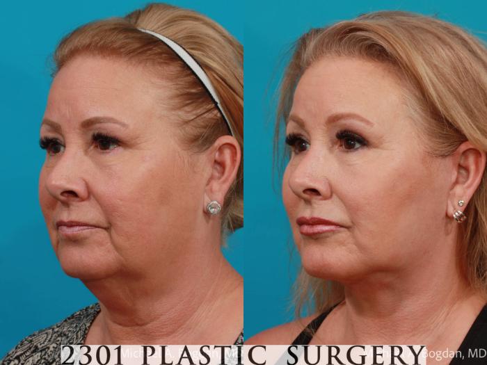 Before & After Face Lift Case 727 Left Oblique View in Fort Worth, Plano, & Frisco, Texas