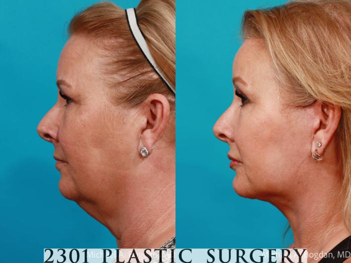 Before & After Face Lift Case 727 Left Side View in Fort Worth, Plano, & Frisco, Texas