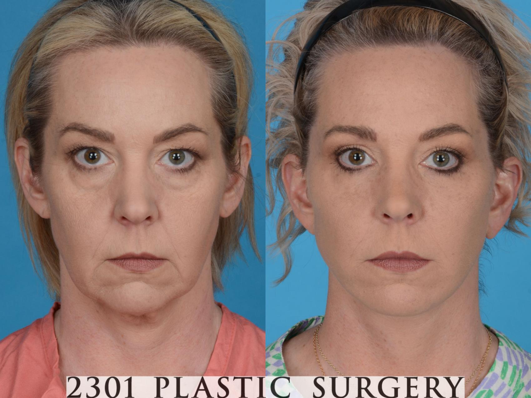 Before & After Blepharoplasty Case 731 Front View in Fort Worth, Plano, & Frisco, Texas
