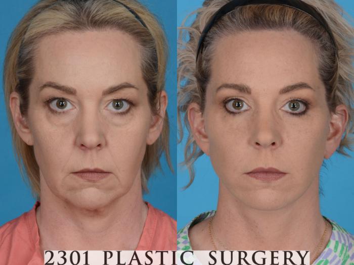 Before & After Neck Lift Case 731 Front View in Fort Worth & Frisco, Texas