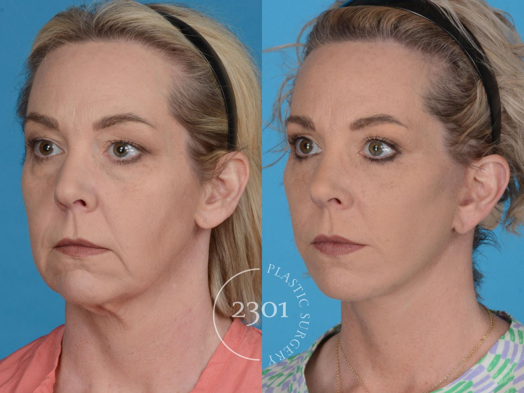 Before & After Face Lift Case 731 Left Oblique View in Fort Worth, Plano, & Frisco, Texas