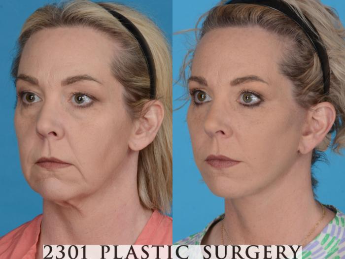 Before & After Face Lift Case 731 Left Oblique View in Fort Worth, Plano, & Frisco, Texas
