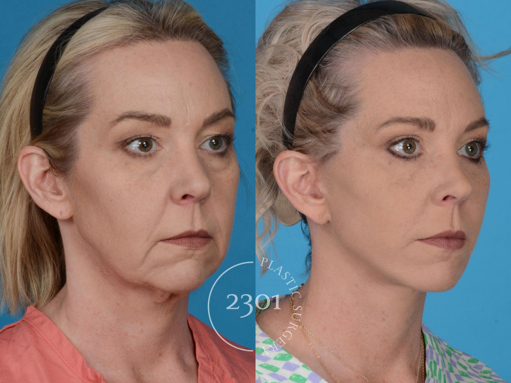 Before & After Blepharoplasty Case 731 Right Oblique View in Fort Worth, Plano, & Frisco, Texas