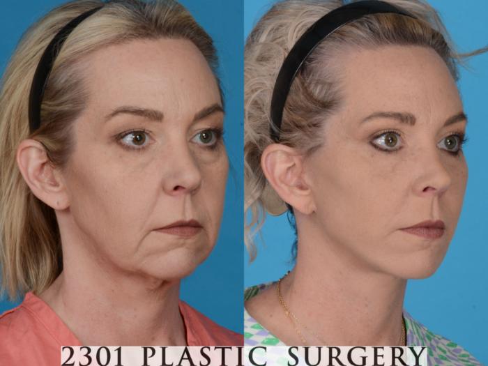 Before & After Face Lift Case 731 Right Oblique View in Fort Worth, Plano, & Frisco, Texas