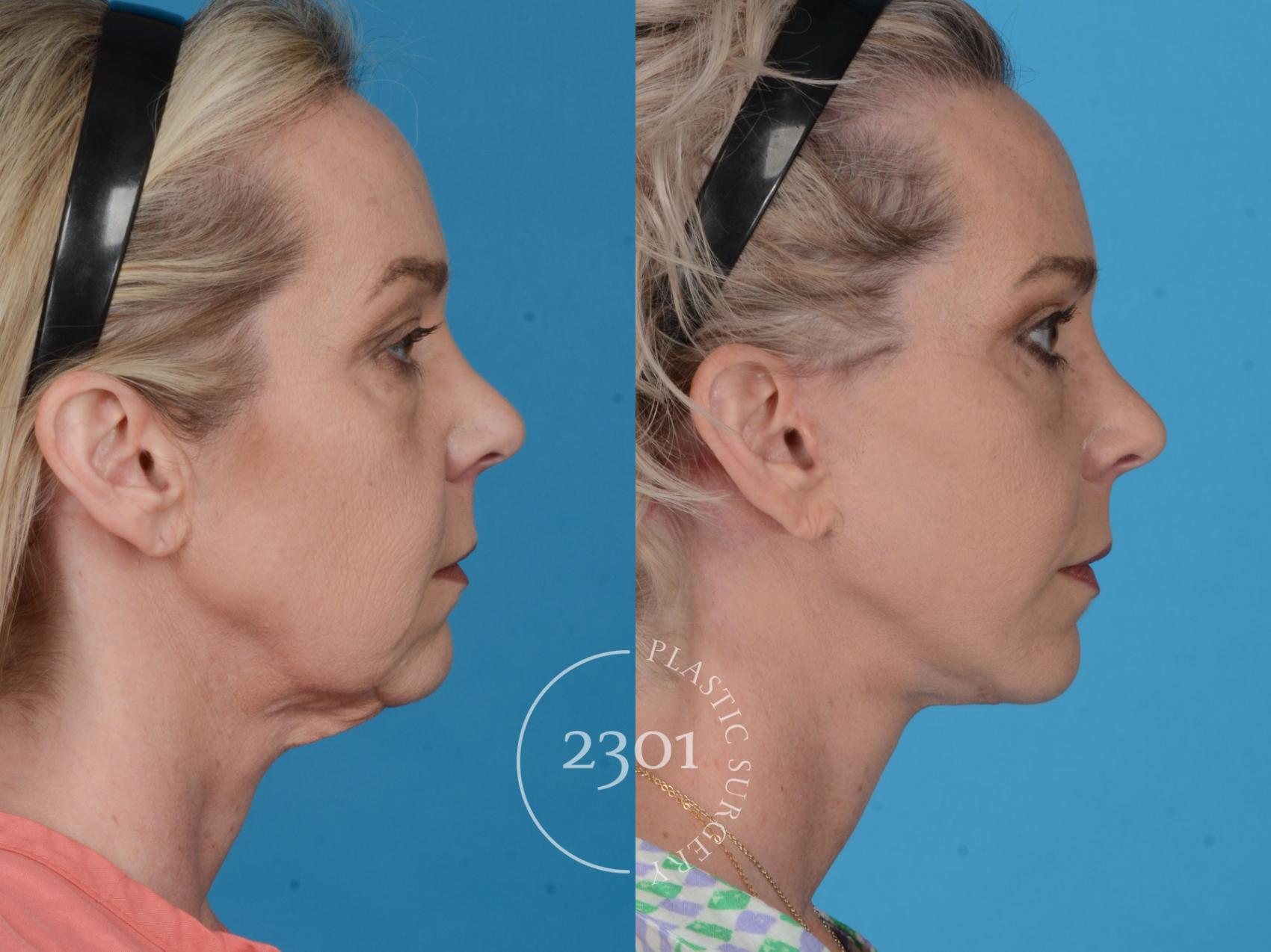 Before & After Blepharoplasty Case 731 Right Side View in Fort Worth, Plano, & Frisco, Texas