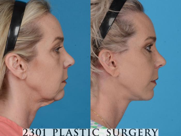 Before & After Blepharoplasty Case 731 Right Side View in Fort Worth, Plano, & Frisco, Texas