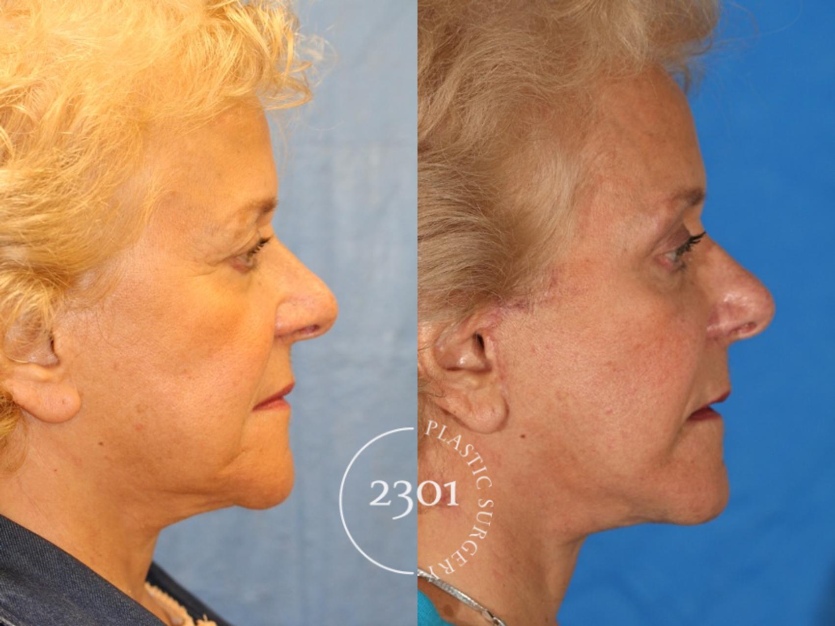Before & After Face Lift Case 75 View #2 View in Fort Worth, Plano, & Frisco, Texas