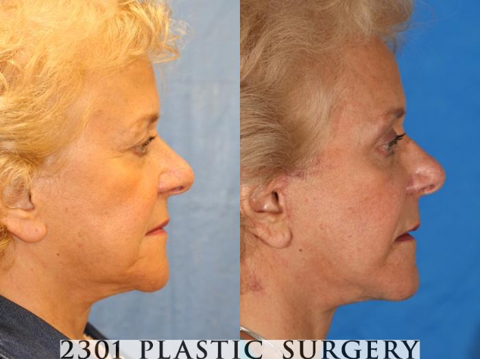 Before & After Brow Lift Case 75 View #2 View in Fort Worth, Plano, & Frisco, Texas
