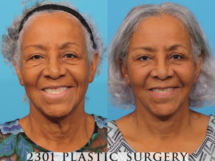 Before & After Blepharoplasty Case 764 Front View in Fort Worth, Plano, & Frisco, Texas