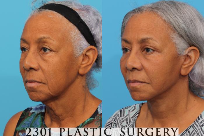 Before & After Blepharoplasty Case 764 Left Oblique View in Fort Worth, Plano, & Frisco, Texas