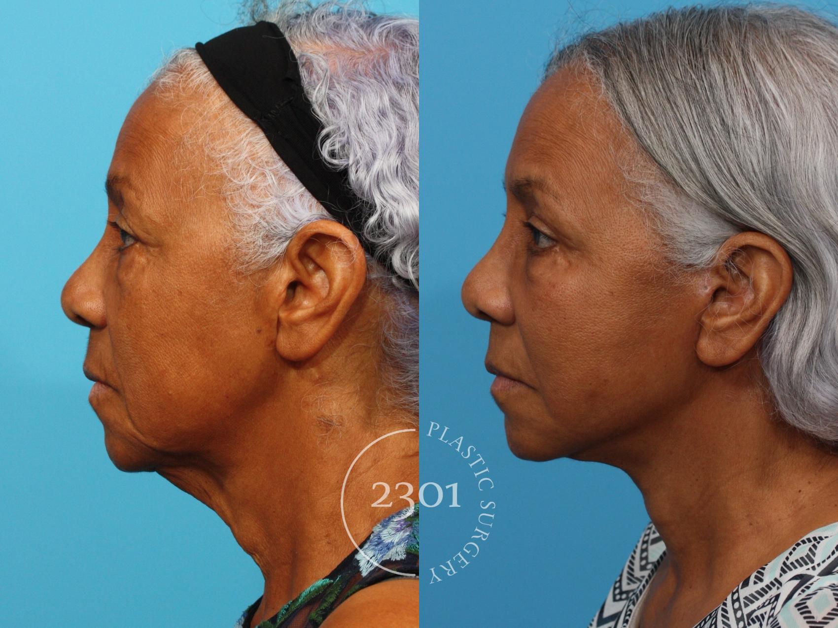Before & After Facial Fat Grafting Case 764 Left Side View in Fort Worth, Plano, & Frisco, Texas